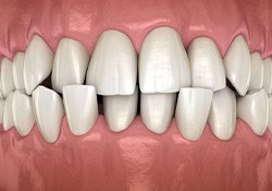 Illustration of a crossbite viewed from the front