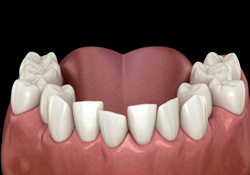 Illustration of crowded teeth in lower dental arch