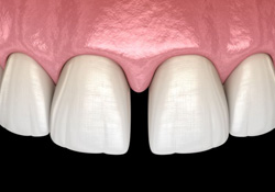 Illustration of a gap between two front teeth