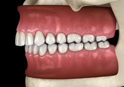 Illustration of a prominent overbite