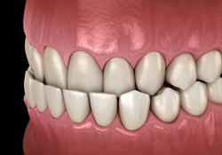 Illustration of an underbite pictured against dark background