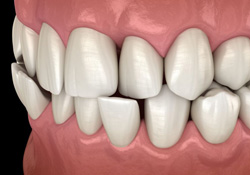 Illustration of a crossbite viewed from side angle