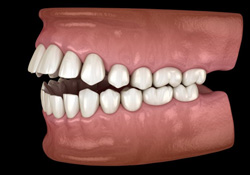 Side-view illustration of a significant open bite